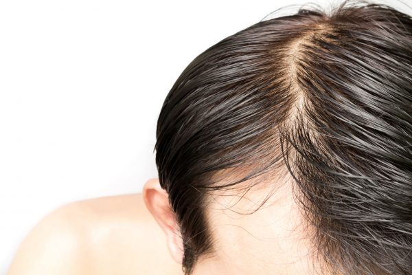 4 Natural Home Remedies To Treat Oily/Greasy Hair