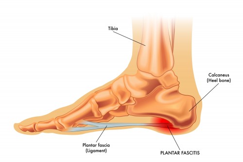 What Is Plantar Fasciitis?