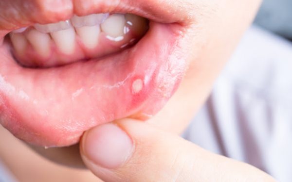 Stages of cold sore development: What to know