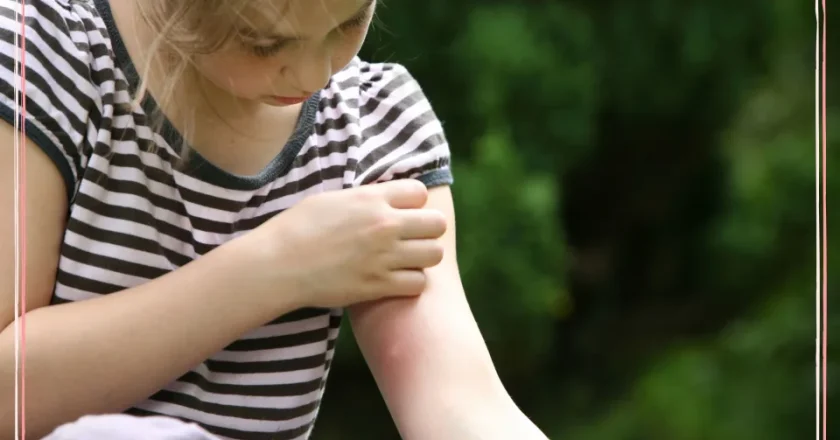 10 natural remedies for insect bites: Expert-approved tips to soothe itching and reduce swelling