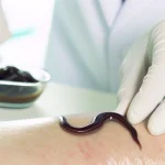 Leech Therapy: A Revival in Modern Wellness