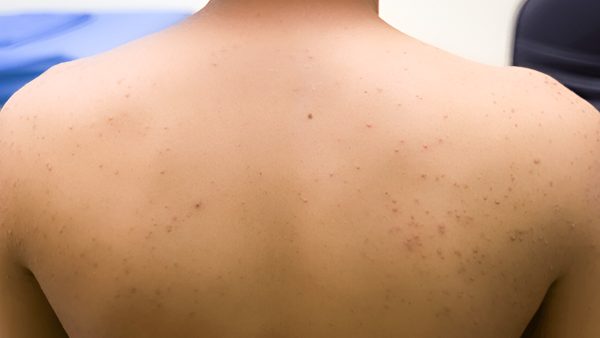 Natural Solutions: Home Remedies for Folliculitis Relief