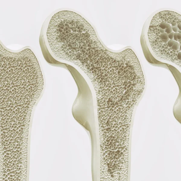 Ten-Year Study Links Tea Drinking to Slightly Stronger Hip Bones in Older Women