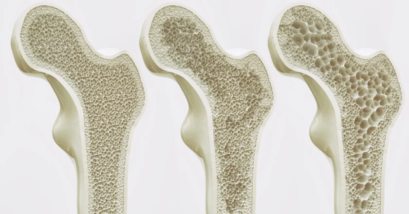 Ten-Year Study Links Tea Drinking to Slightly Stronger Hip Bones in Older Women